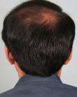 Before Hair Transplant&nbsp;Midscalp
